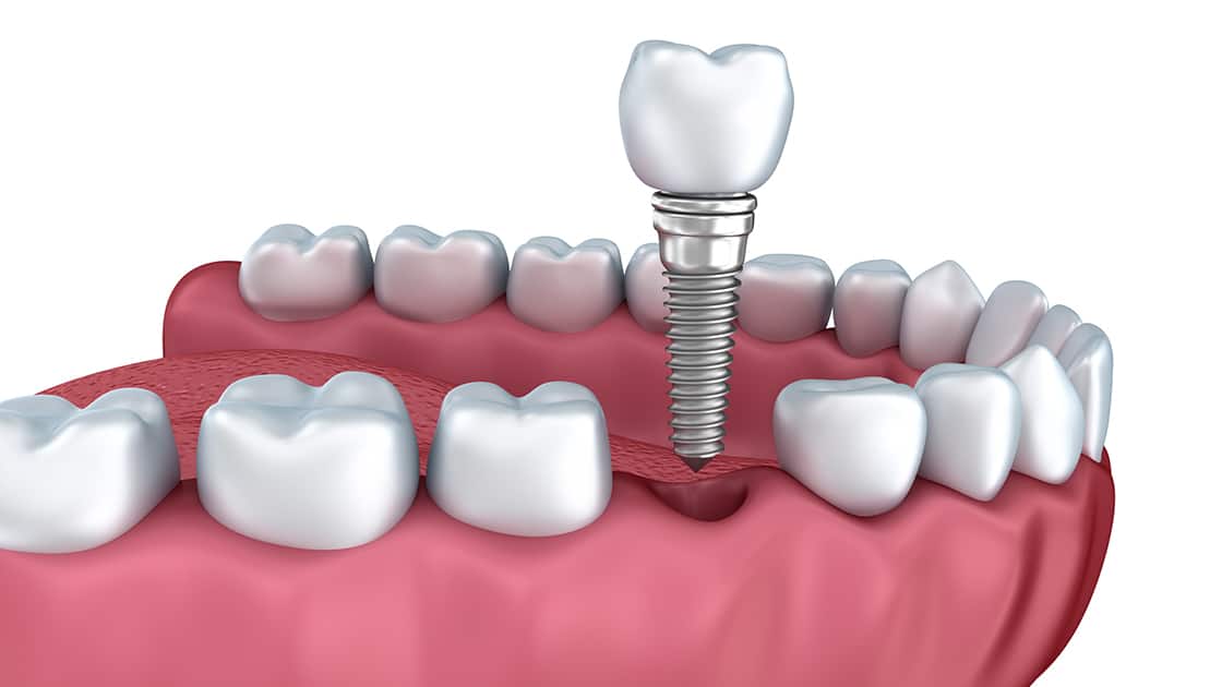 Single Implant Illustration