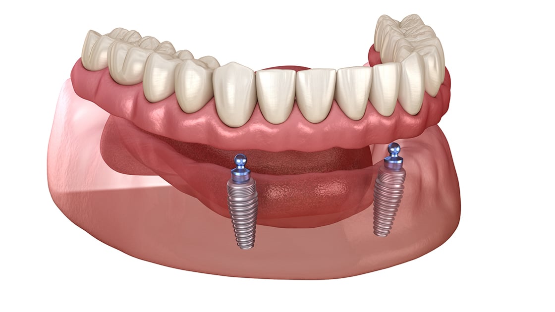 Implant Supported Dentures Photo