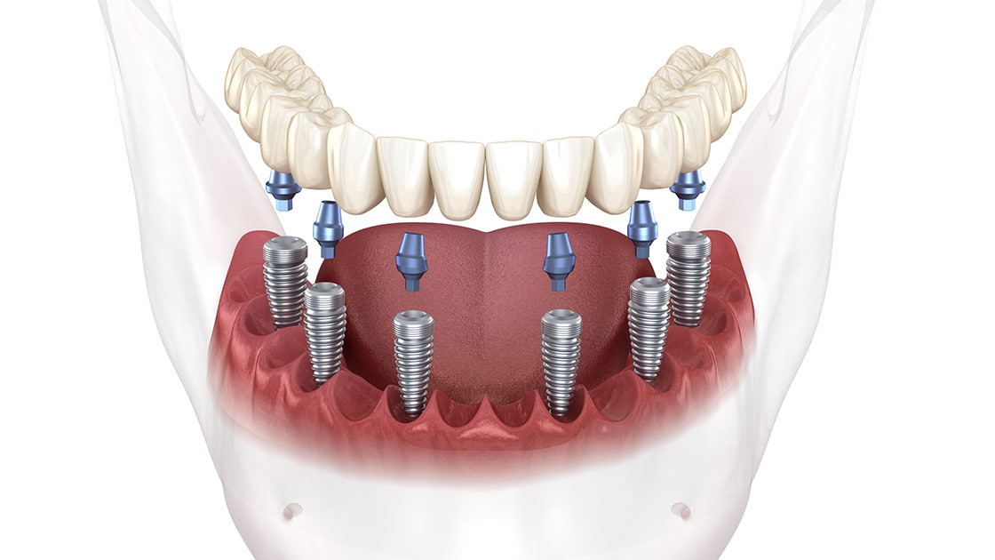 Implant Supported Bridge Decorative Photo