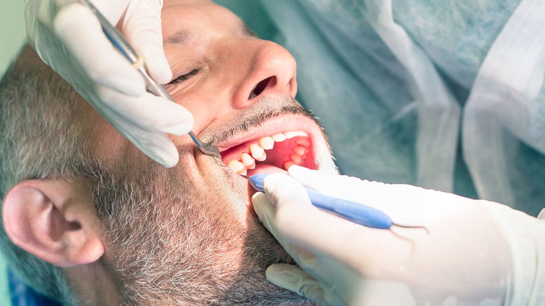 Dental Extraction Image
